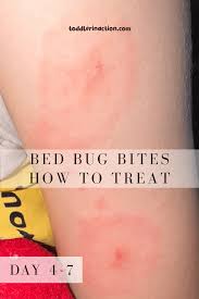 Image result for bedbugs bites