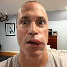 Some people can't survive 1 bee sting. Andrew survived hundreds.