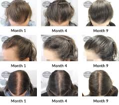See the progression, causes, and treatments for this distressing it ranges from normal hair density to a bald crown, which is rare. Hair Growth Success Story I Couldn T Be Happier Thank You To All The Staff That Helped Me To Achieve These Great Results