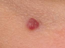 Haemangioma Senilis Angioma Senilis Cherry Angioma Seniele angiomen, worden ook wel angiomata senilis, haemangiomata senilis of ruby spots genoemd. haemangioma senilis angioma senilis