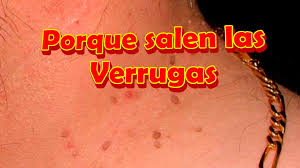 Las verrugas son crecimientos pequeños, no cancerosos, usualmente indoloros en la piel. Pin En Tratamientos