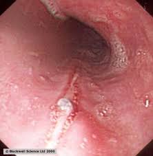 Know its treatment, causes, symptoms, prognosis and the chances of its recurrence. Gastrohep Slide Atlas