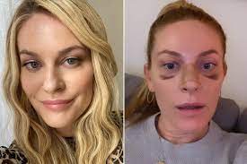 Rhinoplasty is among the 5 most in this app will teach you about surgical rhinoplasty types, compatibility (are you fit for a nose job surgery), rhinoplasty techniques, you'll see before and after. Rhony S Leah Mcsweeney Reveals She Got A Nose Job