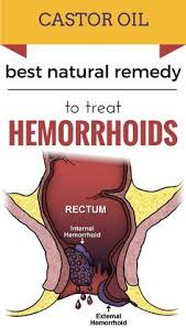 Castor Oil Best Natural Remedy To Treat Hemorrhoids Hemorrhoid Remedies Hemmoroids Treatment Hemorrhoid Relief