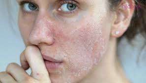 Ingin kulitmu cantik dan putih natural mulai dari wajah hingga kaki? Cara Menguruskan Kulit Kering Dengan 4 Kaedah Ini Hasilnya Kulit Kekal Lembap Dan Segar Hijabista