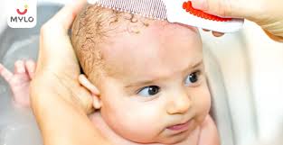 Image result for Cradle Cap