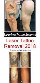 Its location on your body Can A Dermatologist Remove Tattoos How Much Does It Cost To Get Laser Tattoo Removal How To Remove Tattoo Fro Tattooentfernung Diy Tattoo Temporare Tatowierung