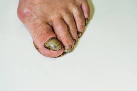 Image result for Onycholysis feet
