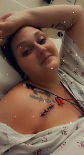 Post 6 week crt-p check wound is healed up severe rash at pacemaker site  initially thought reaction to glue now been referred for allergy testing  from device components !! What are alternative