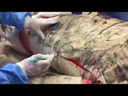 As nouns the difference between fasciotomy and escharotomy is that fasciotomy is (surgery) the cutting of the fascia to relieve tension or pressure (and treat the resulting loss of circulation to an area of tissue or muscle) while escharotomy is a surgical procedure in which an incision is made through eschar to expose the fatty tissue below. Escharotomy Video Chest Jetem 2018 Youtube