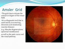 Amsler Grid Types Procedure Of Testing And Clinical Indications Medicomaestro