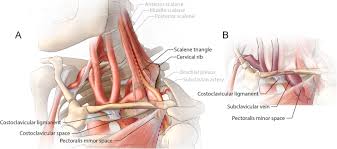 Vascular Thoracic Outlet Syndrome Seminars In Thoracic And Cardiovascular Surgery
