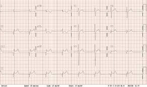 abnormal ecg findings in a young patient with unexplained