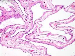 Also referred to as benign multicystic mesothelioma, benign cystic mesothelioma, and bmpm, this type of peritoneal . Webpathology Com A Collection Of Surgical Pathology Images
