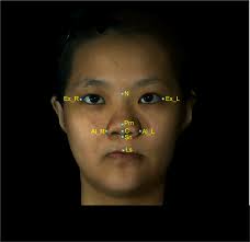Patient- and 3D morphometry-based nose outcomes after skeletofacial  reconstruction