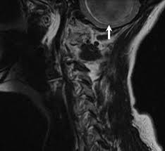 Image result for Incidental Imaging Finding