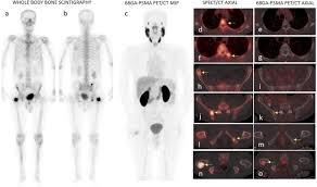 These include your blood pressure, heart rate and metab. Does Bone Scintigraphy Still Have A Role In The Era Of 68 Ga Psma Pet Ct In Prostate Cancer Springerlink