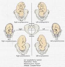 Image result for Manual Rotation in Occipitoposterior Presentation