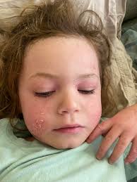 Has anyone dealt with lip licking? He won't stop doing it I've been  treating it with Vaseline and hydrocortisone and trying to remind him not  to do it. it just got bad