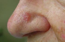 Image result for skin cancer on nose pimple