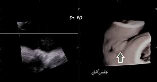 معرفة نوع الجنين في الشهر الرابع بدون سونار