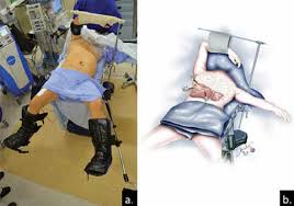 The exact position is indicated by which surface of the body is closest to the flat surface: Patient Position A Semi Left Lateral Decubitus B Position Of The Download Scientific Diagram