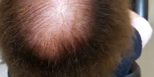 E' possibile pagare a rate il costo del trapianto capelli, trapianto capelli: Infoltimento Capelli Non Chirurgico A Torino Parrucchiere Valenza