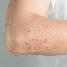 Zona, tıbbi adı ile herpes zoster, vücudun bir tarafını etkileyen ağrılı ve döküntülü bir hastalıktır. Tratament Naturist Zona Zoster Centrul De SÄƒnÄƒtate È™i ViaÈ›Äƒ Armonia