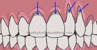You'll be connected to a licensed. Proven Ways To Treat And Heal Gum Infection Gingivitis Naturally