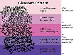 How is prostate cancer treated? Gleason Grading System Wikipedia