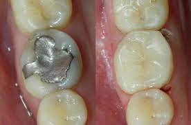 The mixture of these materials allows for a beautiful coloring that closely matches your natural tooth color. White Fillings Woodbridge Vaughn Toronto Brampton