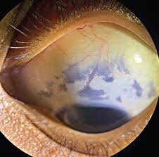 Image result for nevus sclerae