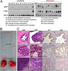 Maybe you would like to learn more about one of these? Prostate Cancer Originating In Basal Cells Progresses To Adenocarcinoma Propagated By Luminal Like Cells Pnas