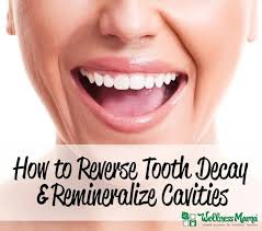 How To Remineralize Teeth Naturally Reverse Tooth Decay Did You Know It S Possible To Remineralize Teeth Naturall Tooth Decay Remineralize Teeth Teeth Health