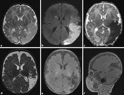(eds) medikamentös induzierte neurologische und psychiatrische störungen. Perinataler Schlaganfall Und Sinusvenenthrombose Klinik Diagnostik Und Therapeutische Ansatze Springerlink