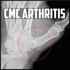 A Review on CMC Joint Arthritis - Sports Medicine Review
