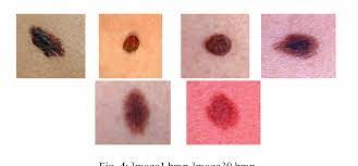 Skin cancer is the abnormal and uncontrolled growth of cells. Early Stage Detection And Classification Of Melanoma Semantic Scholar