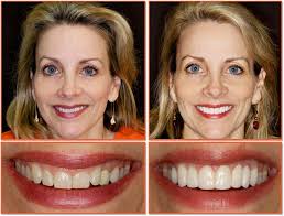 Veneers Midway Family Dental Center