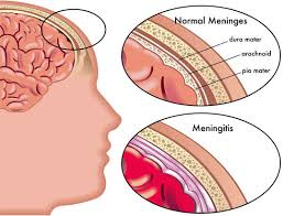Antibiotics can't cure viral meningitis, and most cases improve on their own in several weeks. Meningitis In Children And Babies First Aid For Free