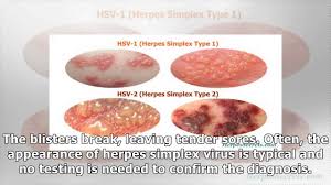 There are two kinds of herpes viruses. How To Treat Herpes Simplex Type 2