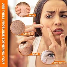 mopayzer Niacinamide 10% + Zinc 1% Serum, Anti-Aging Niacinamide Serum for  Face, 1PCS Moisturizing Facial Serum for All Skin Type, Women Face Skin  Care. : Buy Online at Best Price in KSA -