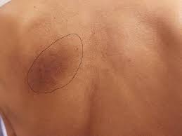 Image result for Notalgia Paresthetica