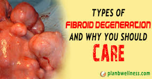 Image result for fibroid