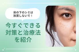 目の下のシミは放置しないで！今すぐできる対策と治療法を紹介 | 梅田すずらんクリニックブログ