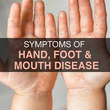 Image result for Hand foot and mouth disease HFMD roof of mouth