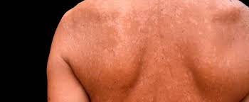 An overabundance of the fungus is what will cause the infection to develop. Pityriasis Versicolor Kleienpilzflechte Symptome Therapie