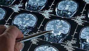 If the tumor is deteriorating the brain stem, the animal's ability to walk, mental alertness and the respiratory and cardiovascular systems could be damaged. Skull Base Tumors Johns Hopkins Medicine
