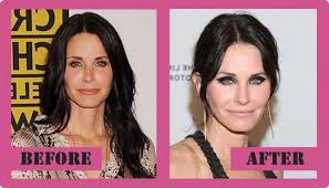 To revisit this article, sele. Courteney Cox Plastic Surgery Botox Injections