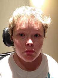 Maroteaux Lamy Syndrome Springerlink