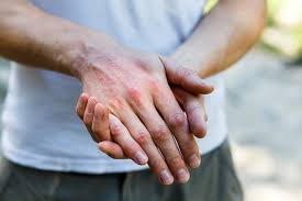 Download discussion guide & info on rx treatment option for adults with active psa. Psoriatic Arthritis Symptoms Treatment Clinical Trials Genesis Research Services